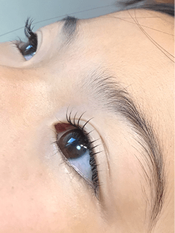 Eye施術例6
